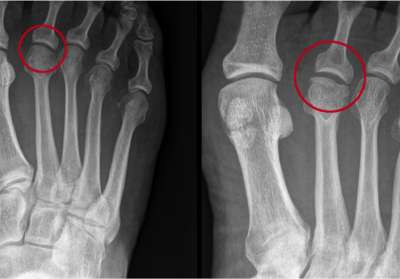 Las personas con el dedo gordo del pie más corto que el segundo dedo, tienen más riesgo de padecer la Enfermedad de Freiberg